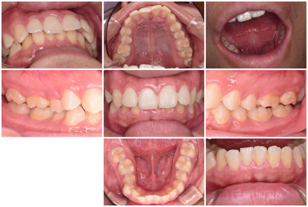矯正治療の目的 3 矯正治療の目的 3 2048x1379 1 矯正治療の目的